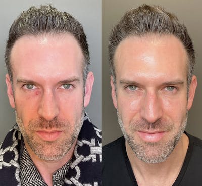 Cheek Filler Before & After Gallery - Patient 116819 - Image 1