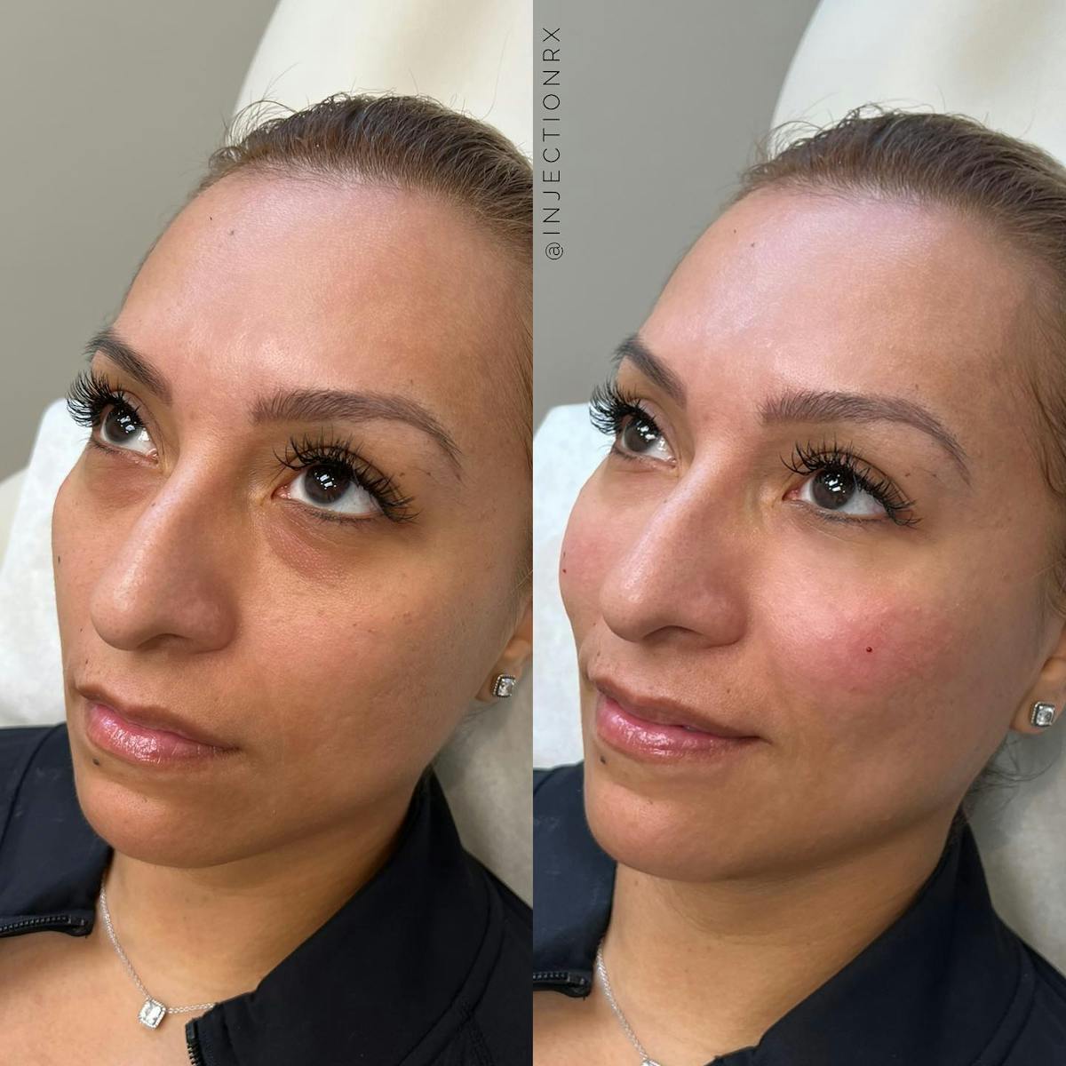 Cheek Filler Before & After Gallery - Patient 250835 - Image 1