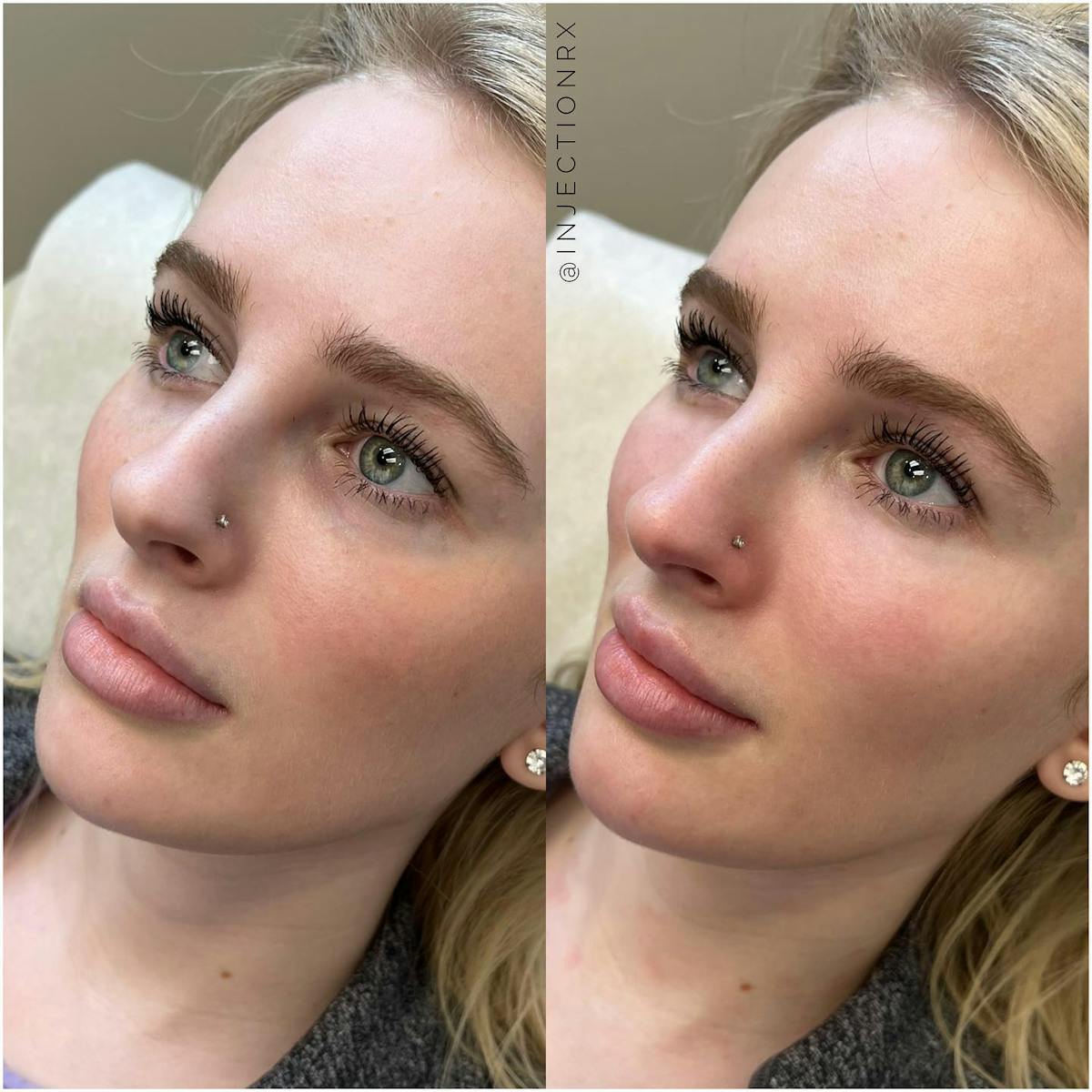 Cheek Filler Before & After Gallery - Patient 141120 - Image 1