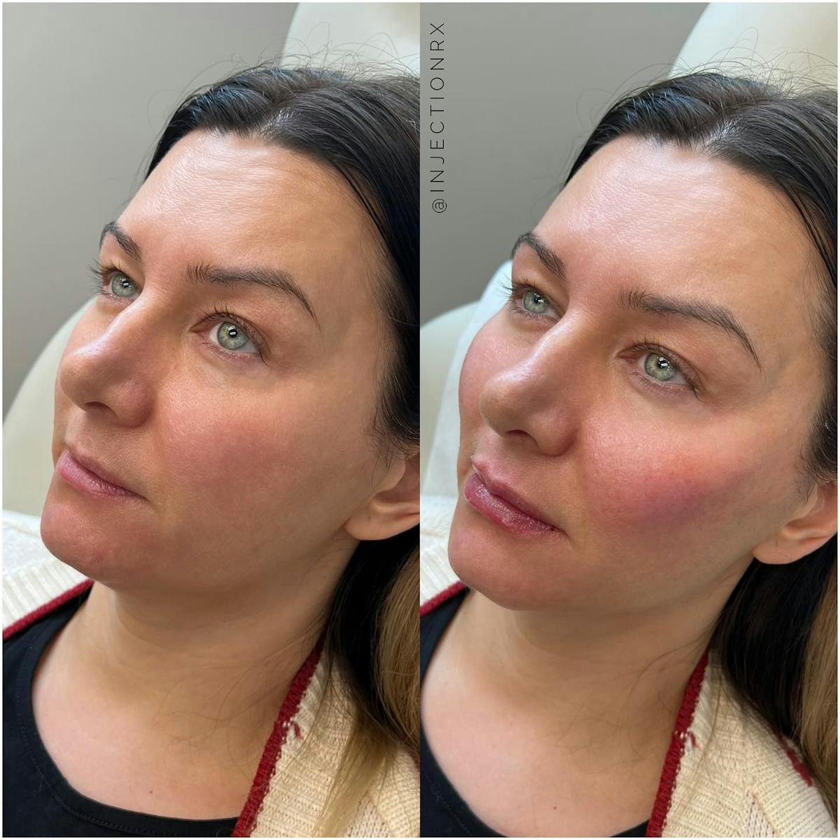 Cheek Filler Before & After Gallery - Patient 405091 - Image 1
