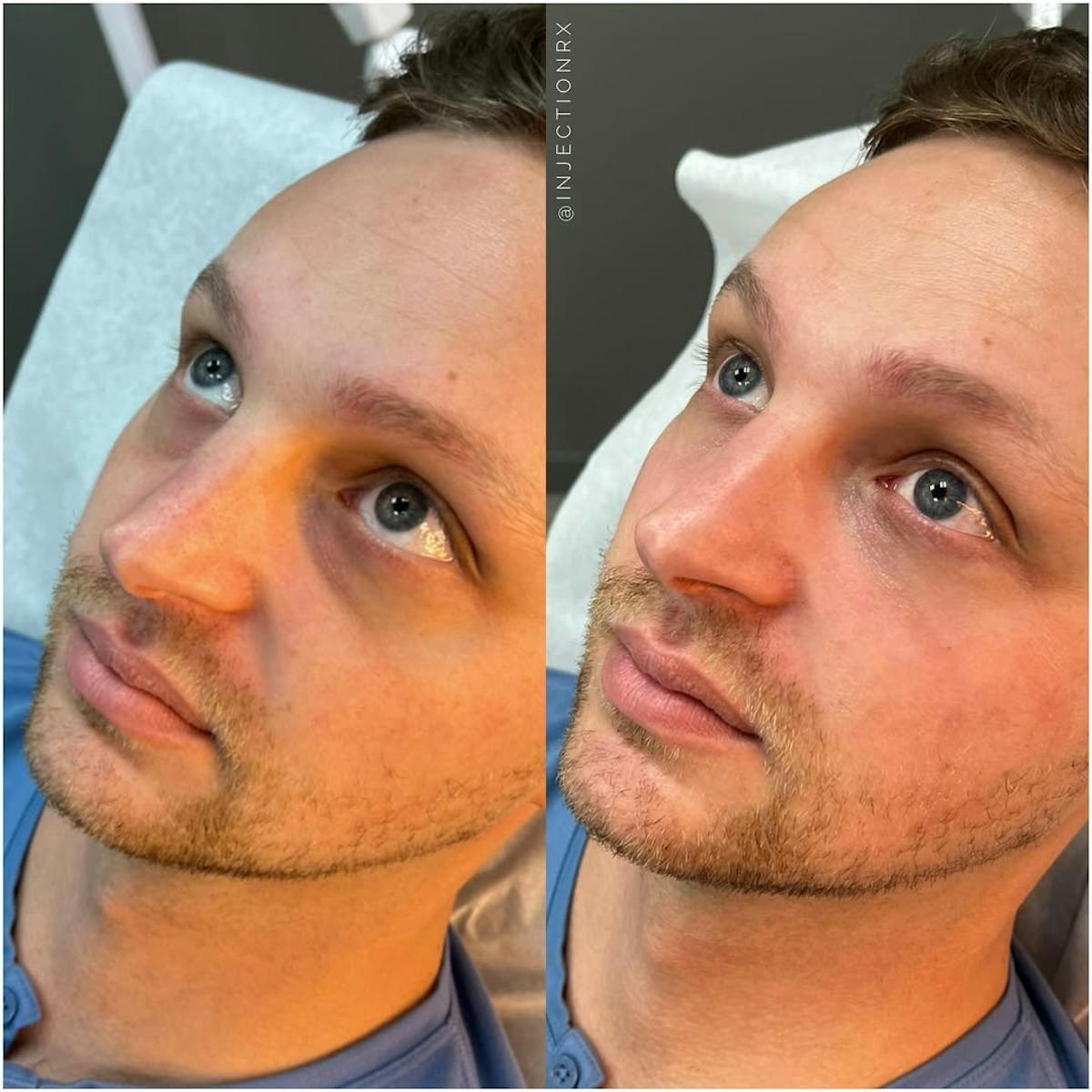 Undereye Filler Before & After Gallery - Patient 330937 - Image 1