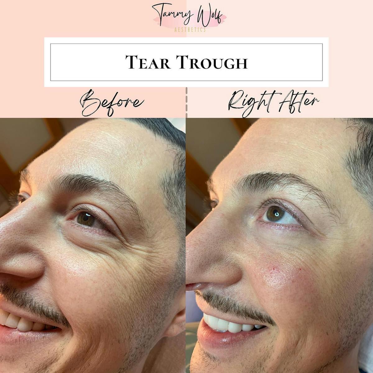 Undereye Filler Before & After Gallery - Patient 223986 - Image 1