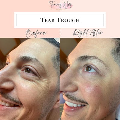 Undereye Filler Before & After Gallery - Patient 223986 - Image 1