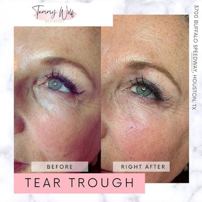 Undereye Filler Before & After Gallery - Patient 107271 - Image 1