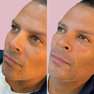 Undereye Filler Before & After Gallery - Patient 391847 - Image 1