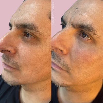 Undereye Filler Before & After Gallery - Patient 235892 - Image 1