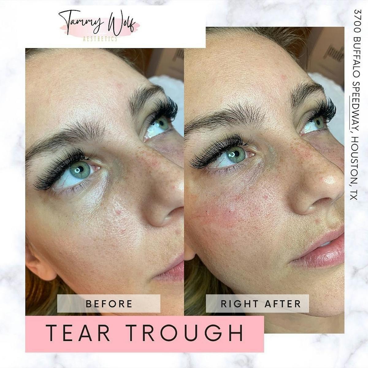 Undereye Filler Before & After Gallery - Patient 426213 - Image 1