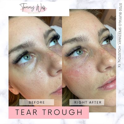 Undereye Filler Before & After Gallery - Patient 426213 - Image 1
