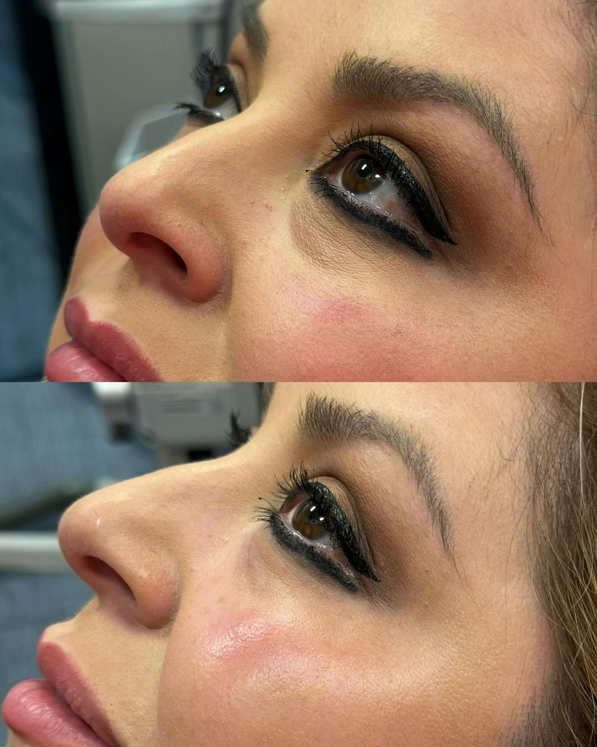 Undereye Filler Before & After Gallery - Patient 145491 - Image 1