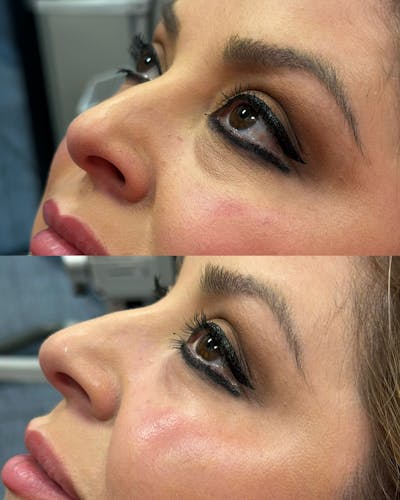 Undereye Filler Before & After Gallery - Patient 145491 - Image 1