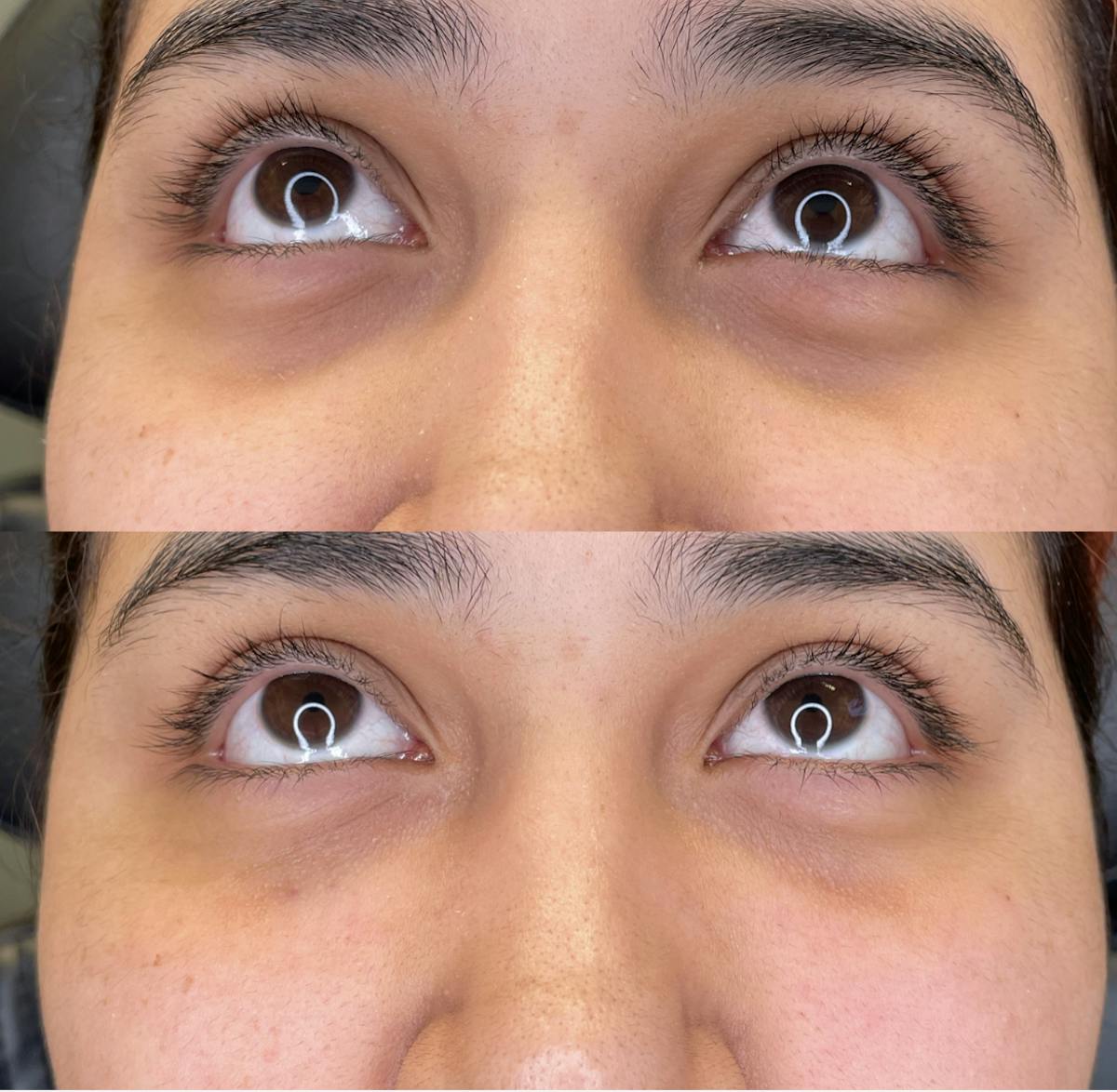 Undereye Filler Before & After Gallery - Patient 189603 - Image 1