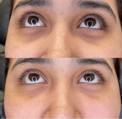 Undereye Filler Before & After Gallery - Patient 189603 - Image 1