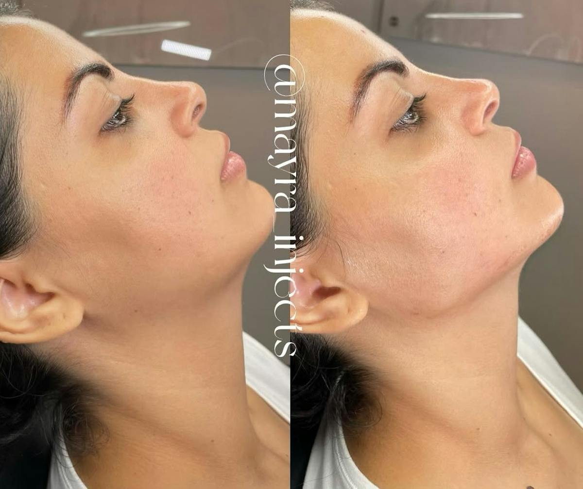 Jawline Filler Before & After Gallery - Patient 189633 - Image 1