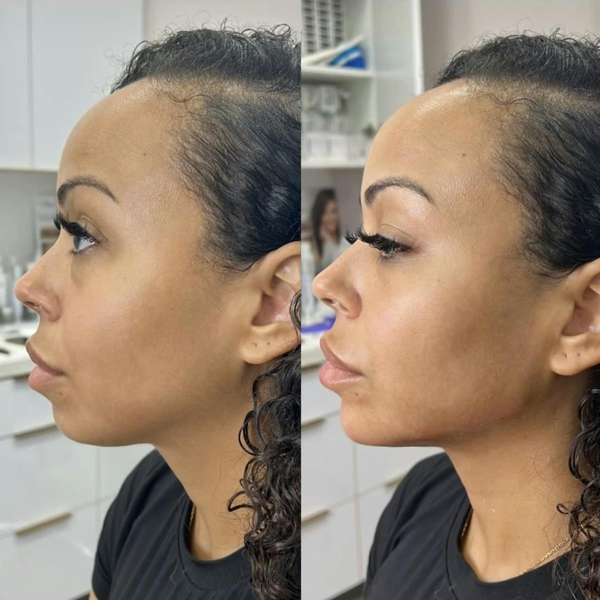 Chin Filler Before & After Gallery - Patient 306437 - Image 1