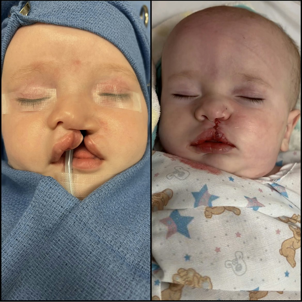 before and after photo of baby with cleft lip procedure