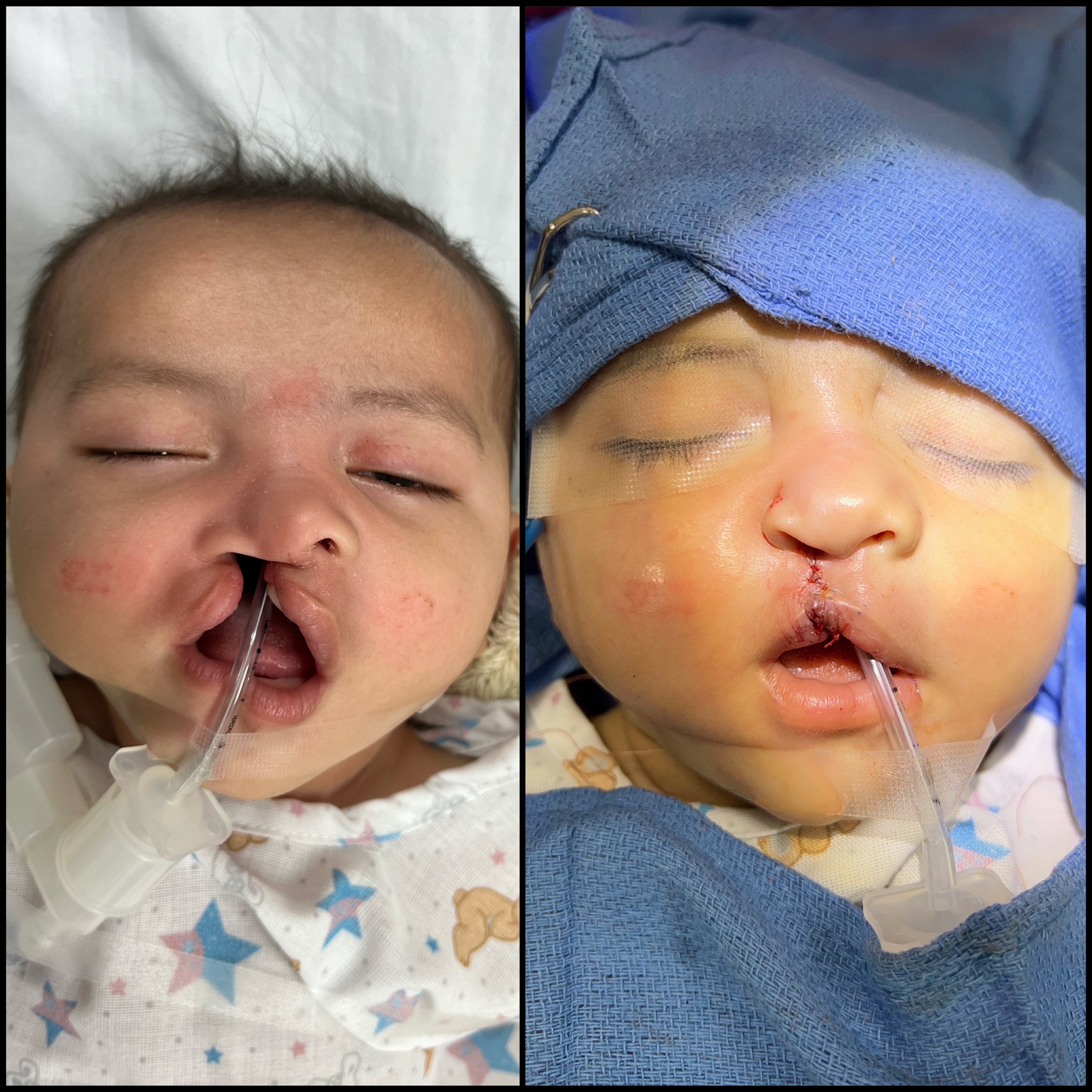 baby with cleft lip before and after 