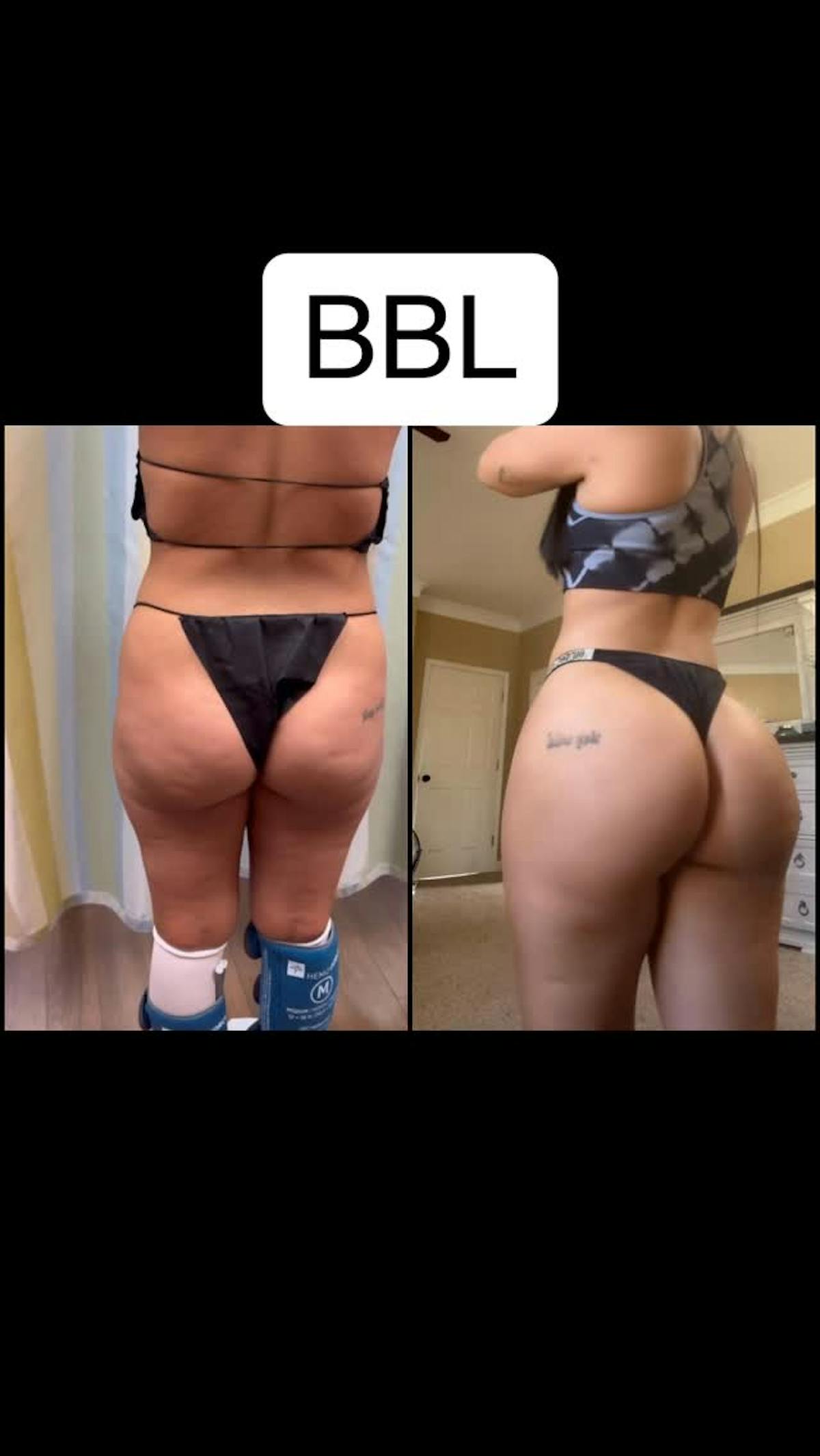 Reels Gallery Before & After Gallery - Patient 305387 - Image 1