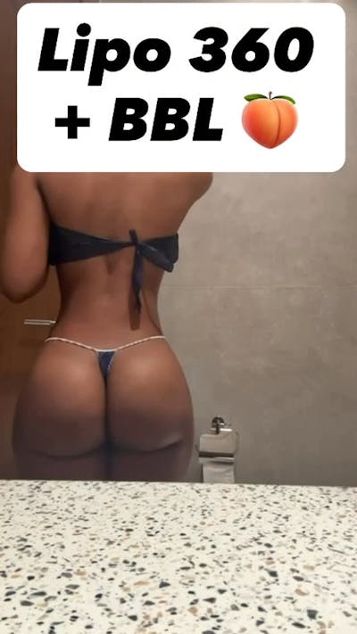 Reels Gallery Before & After Gallery - Patient 173431 - Image 1