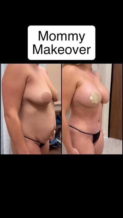 Reels Gallery Before & After Gallery - Patient 373403 - Image 1