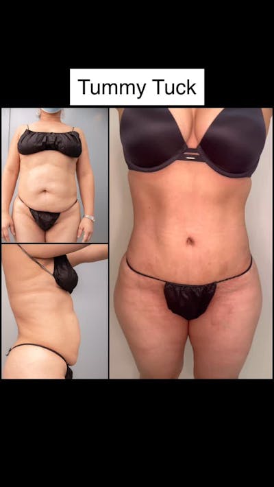 Reels Gallery Before & After Gallery - Patient 341165 - Image 1