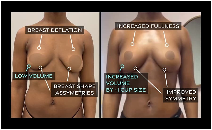 Fat Transfer Breast Augmentation before and after images