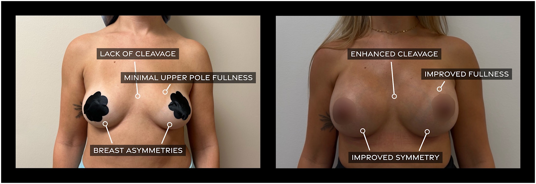 Breast Augmentation before and after images