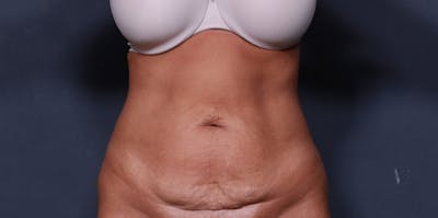 Tummy Tuck Gallery - Patient 42751446 - Image 1