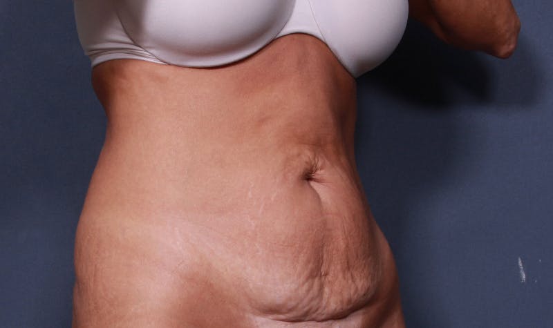 Tummy Tuck Gallery - Patient 42751446 - Image 3