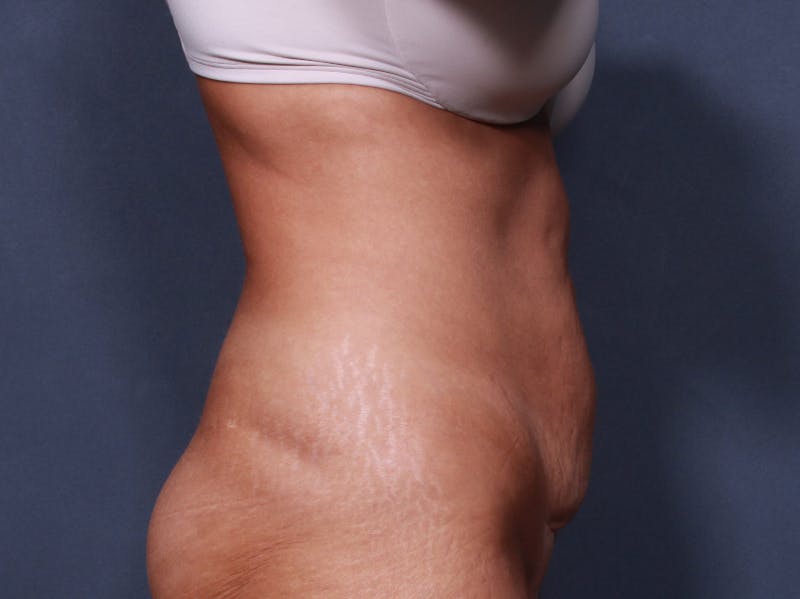 Tummy Tuck Gallery - Patient 42751446 - Image 5