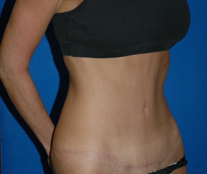 Tummy Tuck Gallery - Patient 42751446 - Image 4