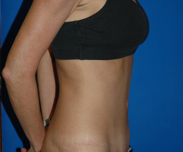 Tummy Tuck Gallery - Patient 42751446 - Image 6