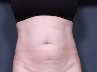 Tummy Tuck Gallery - Patient 42751453 - Image 1