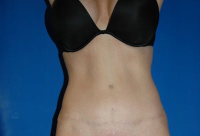 Tummy Tuck Gallery - Patient 42751453 - Image 2