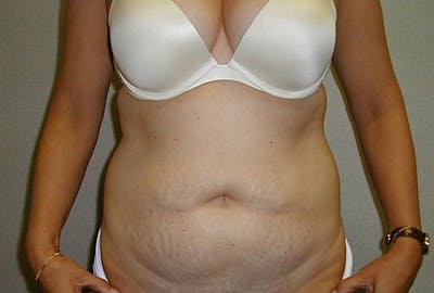 Tummy Tuck Gallery - Patient 42751482 - Image 1