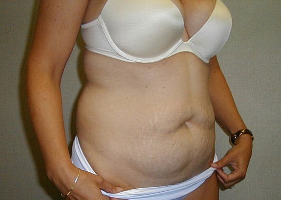 Tummy Tuck Gallery - Patient 42751482 - Image 3