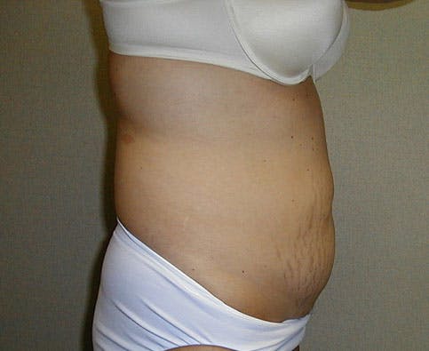 Tummy Tuck Gallery - Patient 42751482 - Image 5