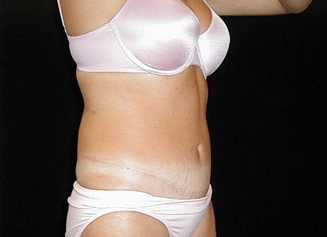 Tummy Tuck Gallery - Patient 42751482 - Image 4