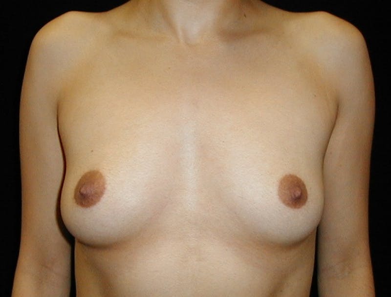 Breast Augmentation Gallery - Patient 42751486 - Image 1