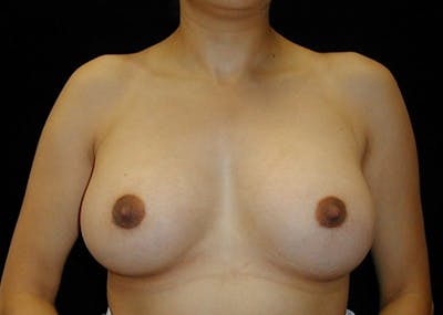 Breast Augmentation Gallery - Patient 42751486 - Image 2