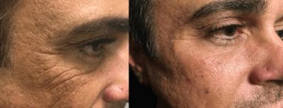 PDO Thread Lift  Before & After Gallery - Patient 53599854 - Image 1