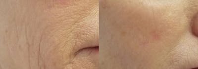 PDO Thread Lift Before & After Gallery - Patient 49261289 - Image 1