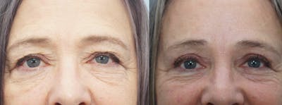 Brow Lift Before & After Gallery - Patient 47121820 - Image 1