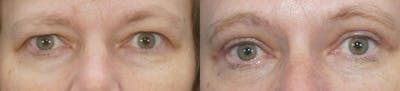 Brow Lift Before & After Gallery - Patient 47121888 - Image 1