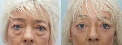 Brow Lift Before & After Gallery - Patient 47121965 - Image 1