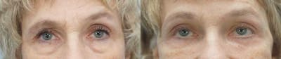 Brow Lift Before & After Gallery - Patient 47122006 - Image 1