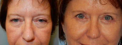 Brow Lift Before & After Gallery - Patient 47122040 - Image 1