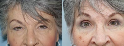 Brow Lift Before & After Gallery - Patient 47122080 - Image 1