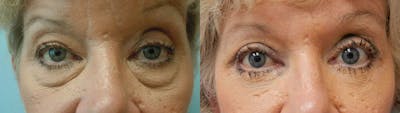 Brow Lift Before & After Gallery - Patient 47122093 - Image 1