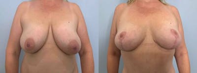 Breast Reduction Before & After Gallery - Patient 47122190 - Image 1
