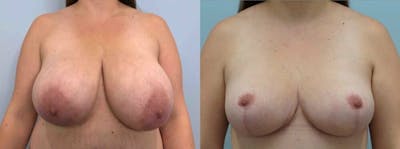 Breast Reduction Before & After Gallery - Patient 47122252 - Image 1
